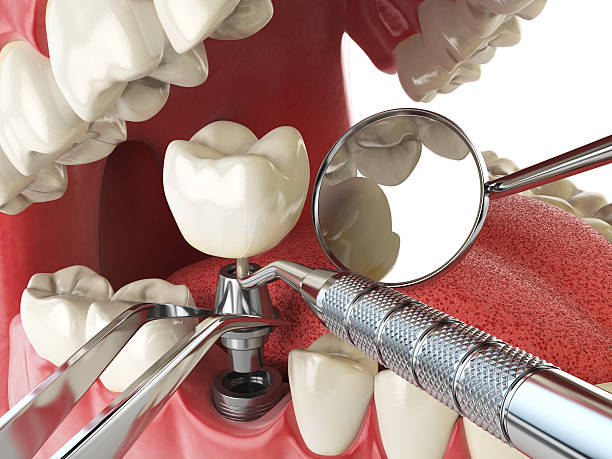 Trusted ID Emergency Dentist Experts